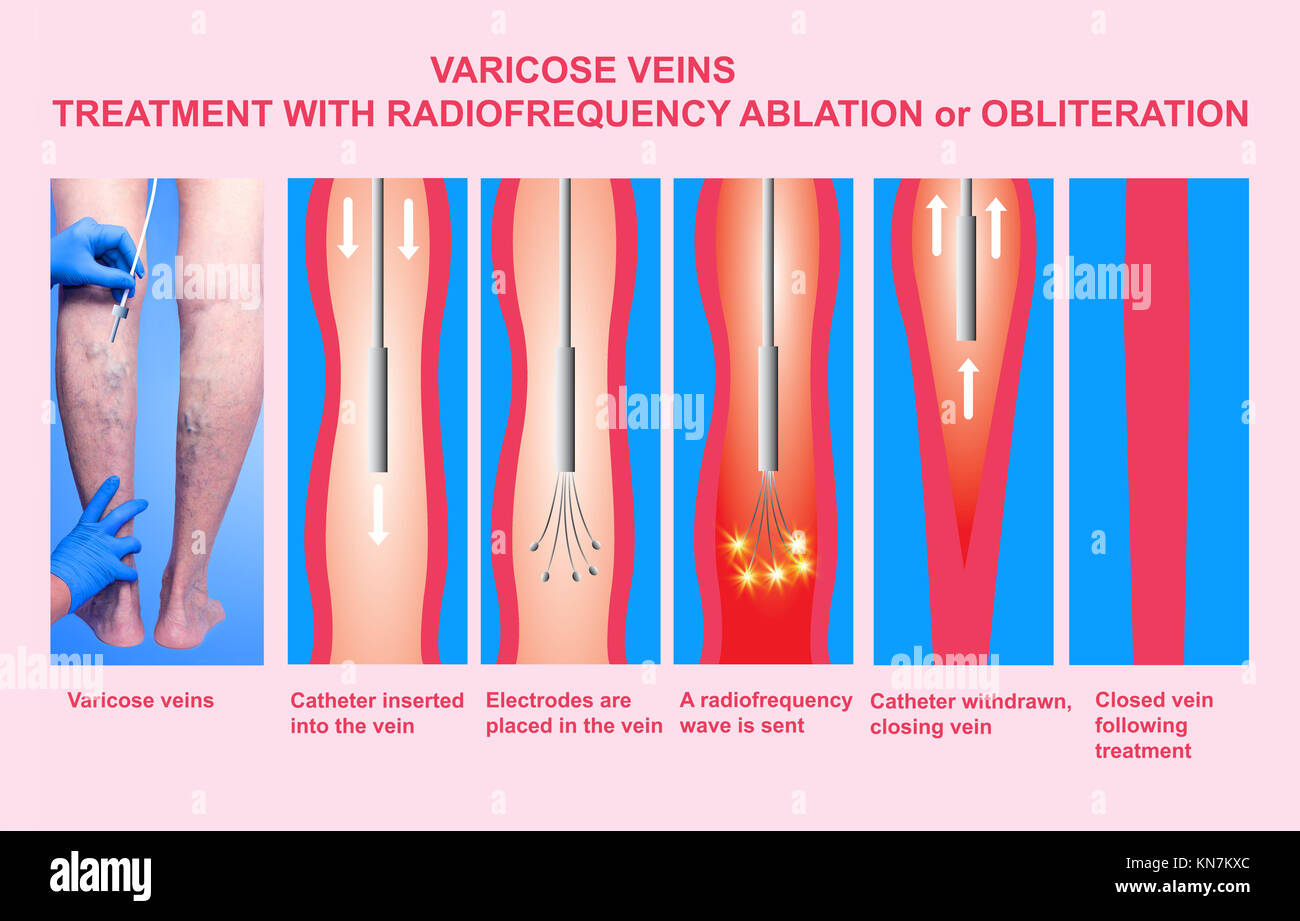 Varicose Veins. Treatment with radiofrequency ablation orobliteration of  female legs Stock Photo - Alamy