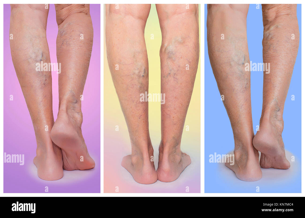 The female legs with veins varicose spider at studio. Collage. Painful