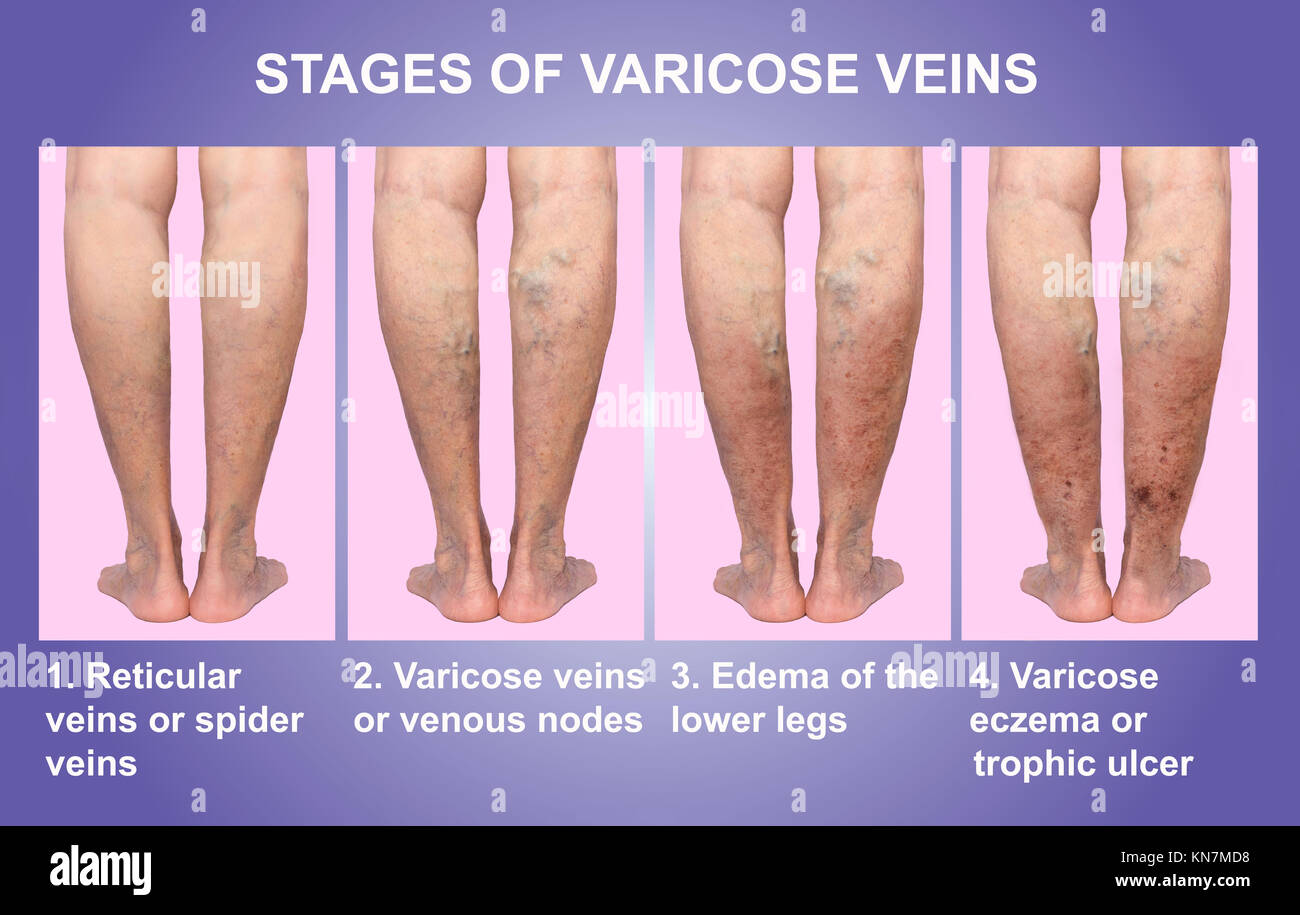 Varicose veins on a female senior legs. The stages of varicose veins