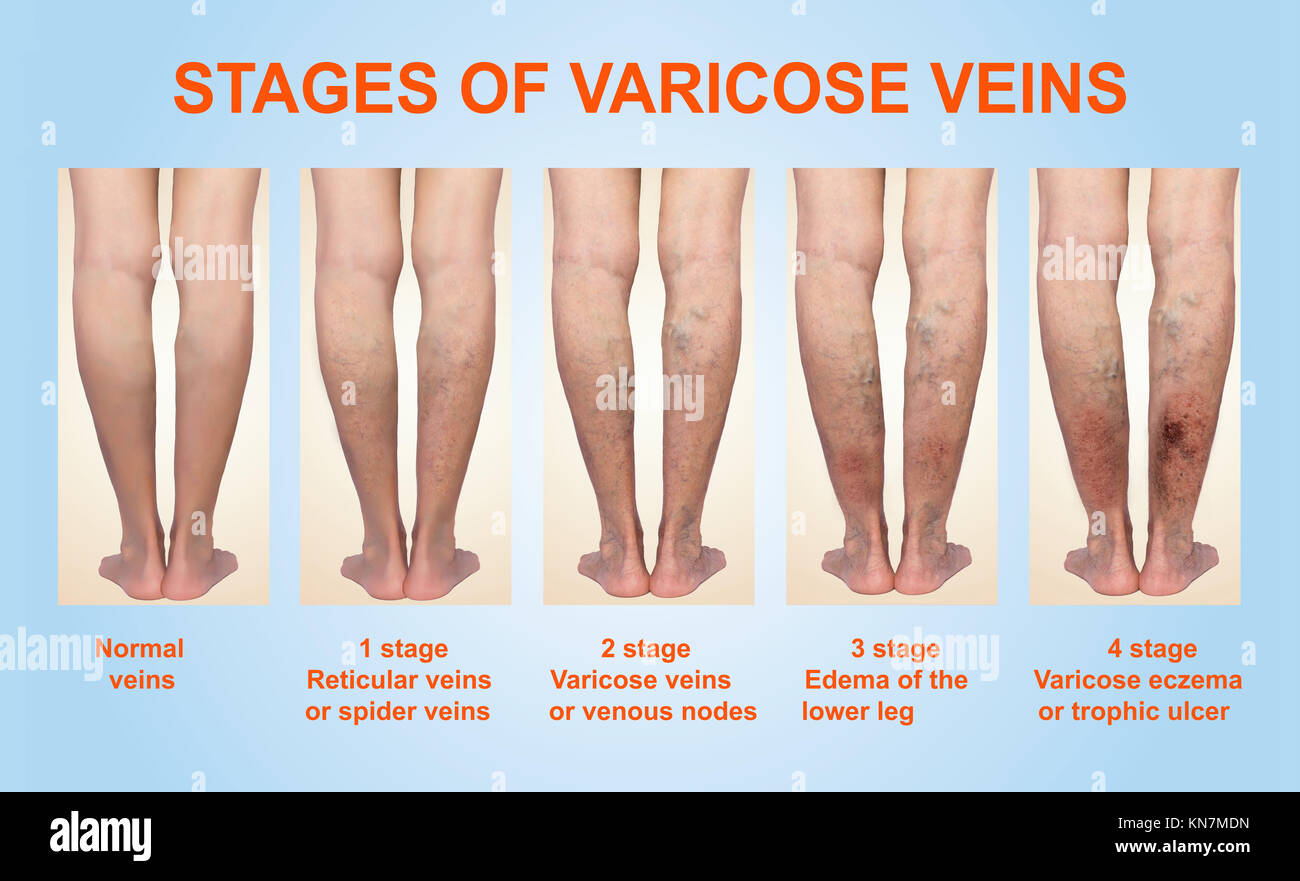 Varicose veins on a female senior legs. The stages of varicose veins Stock Photo