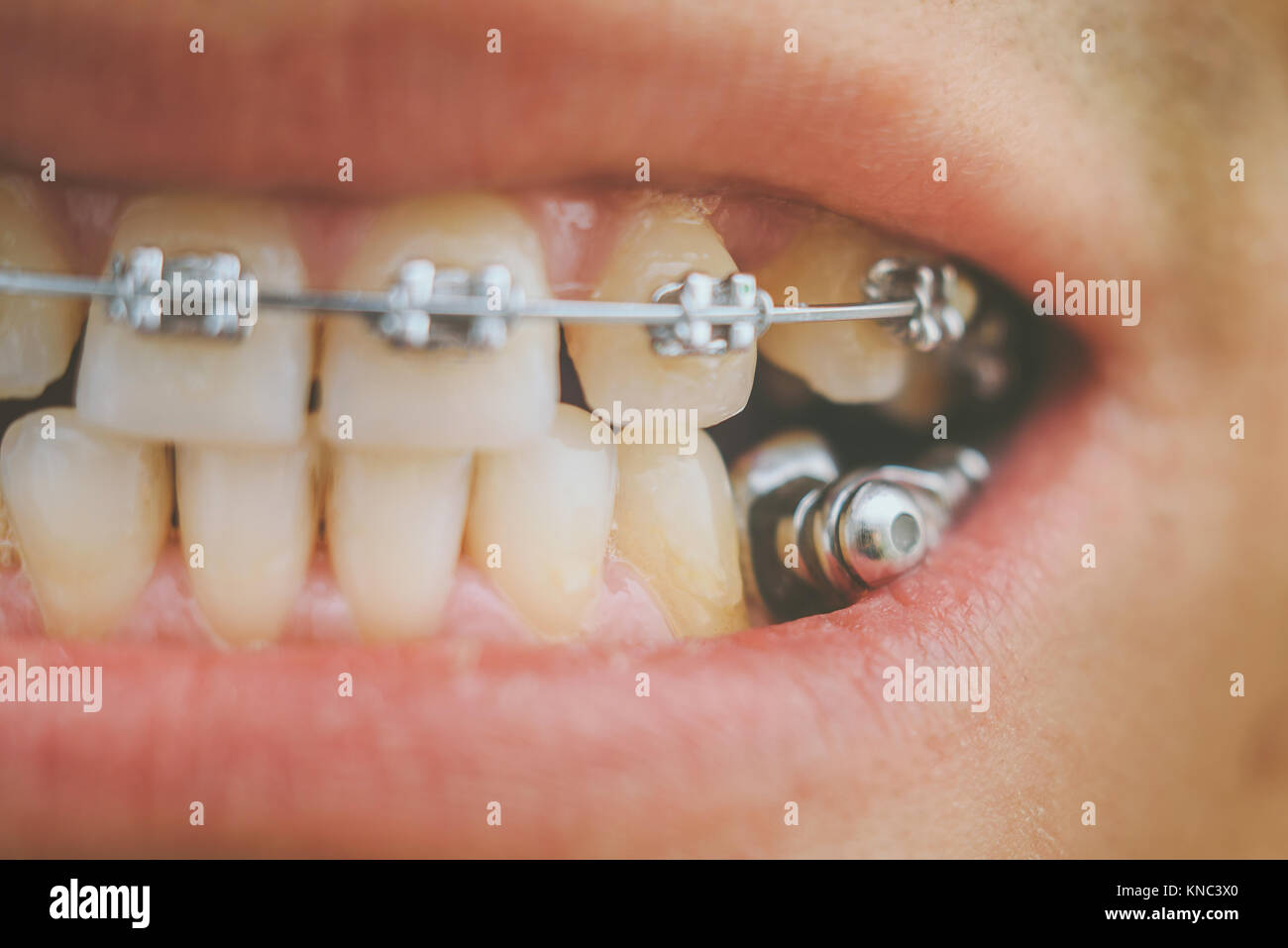 Dental appliance for deep bite Stock Photo 168067592 Alamy