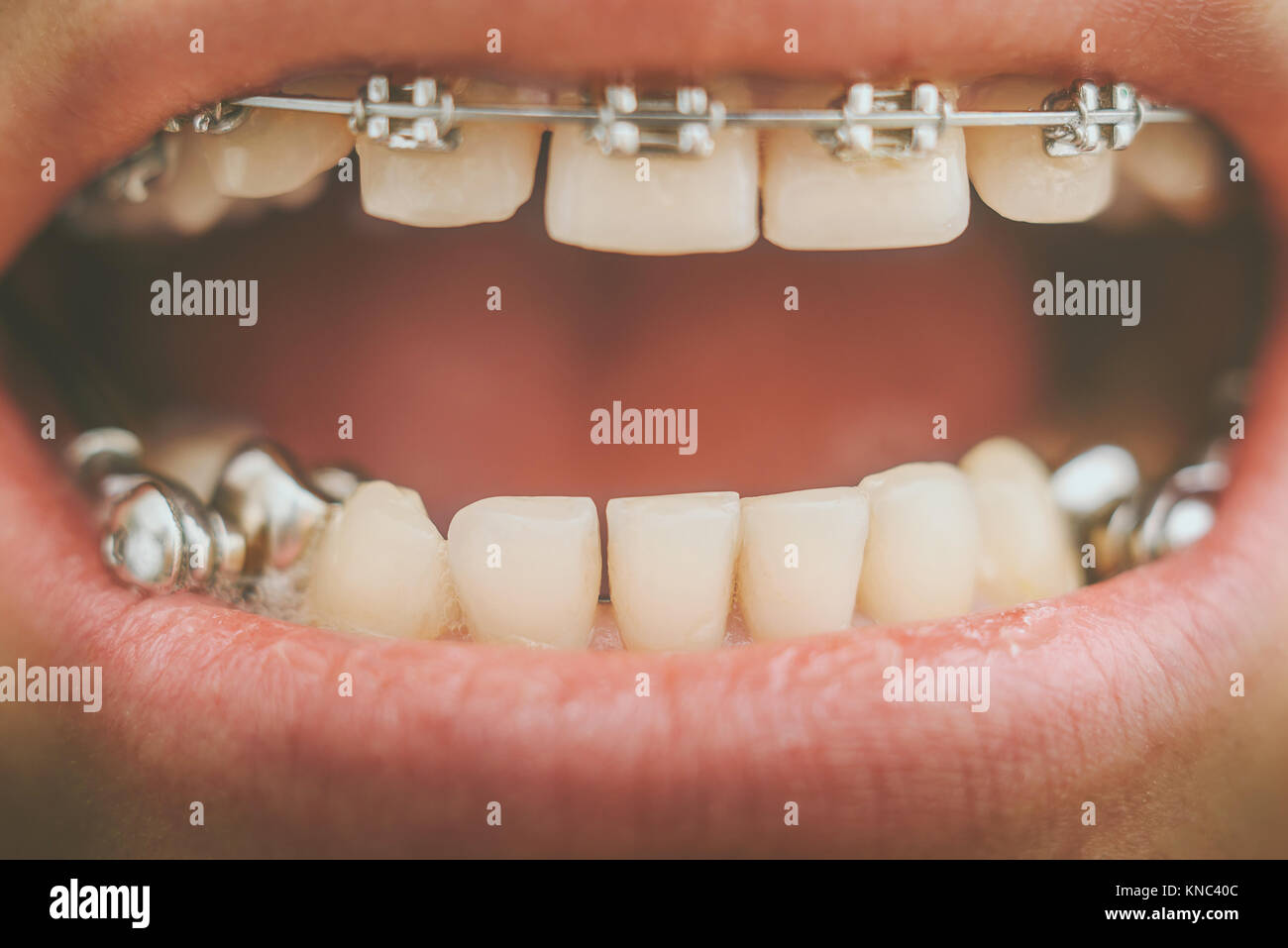 Dental appliance for deep bite Stock Photo Alamy