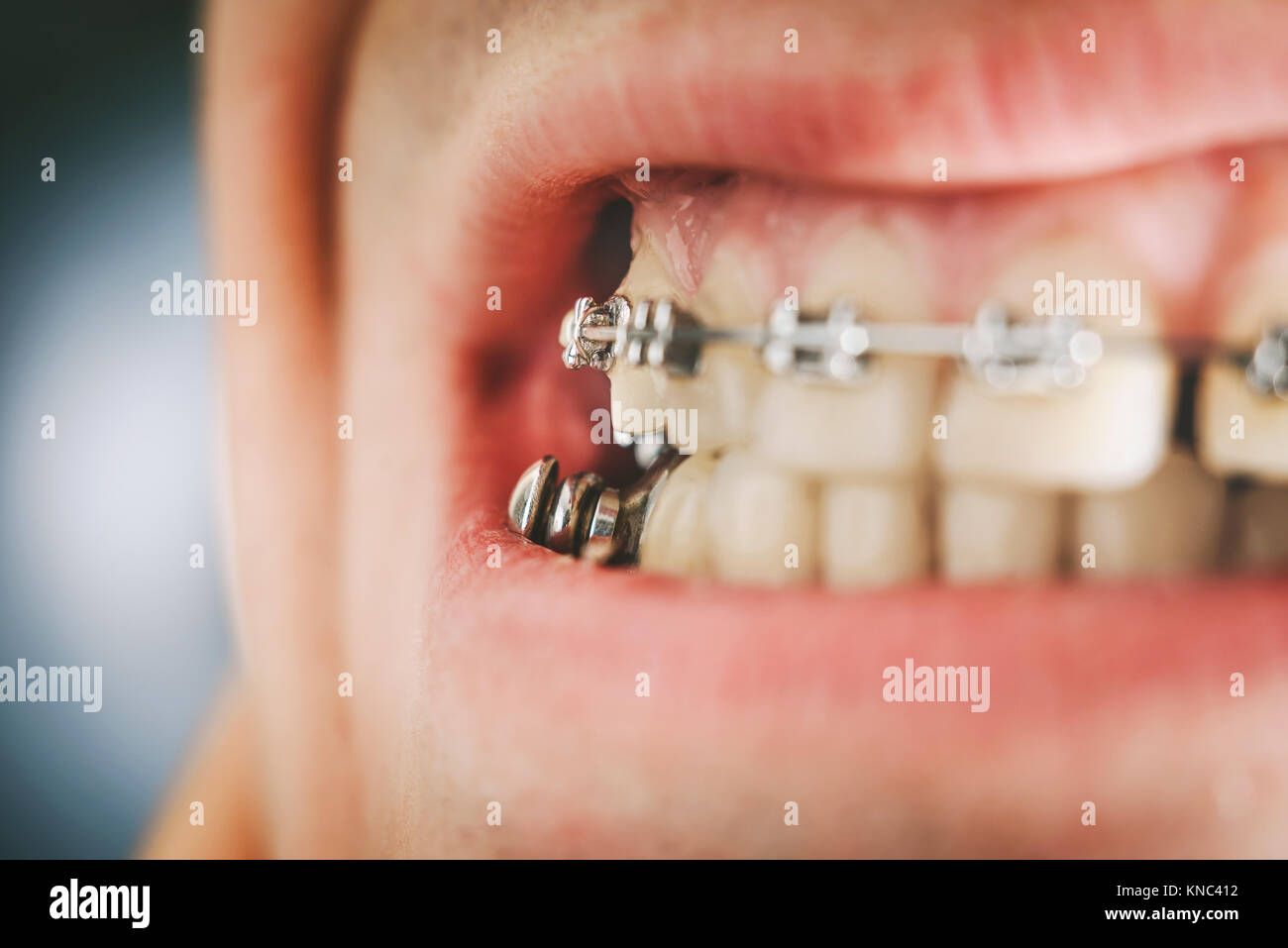 Dental appliance for deep bite Stock Photo Alamy