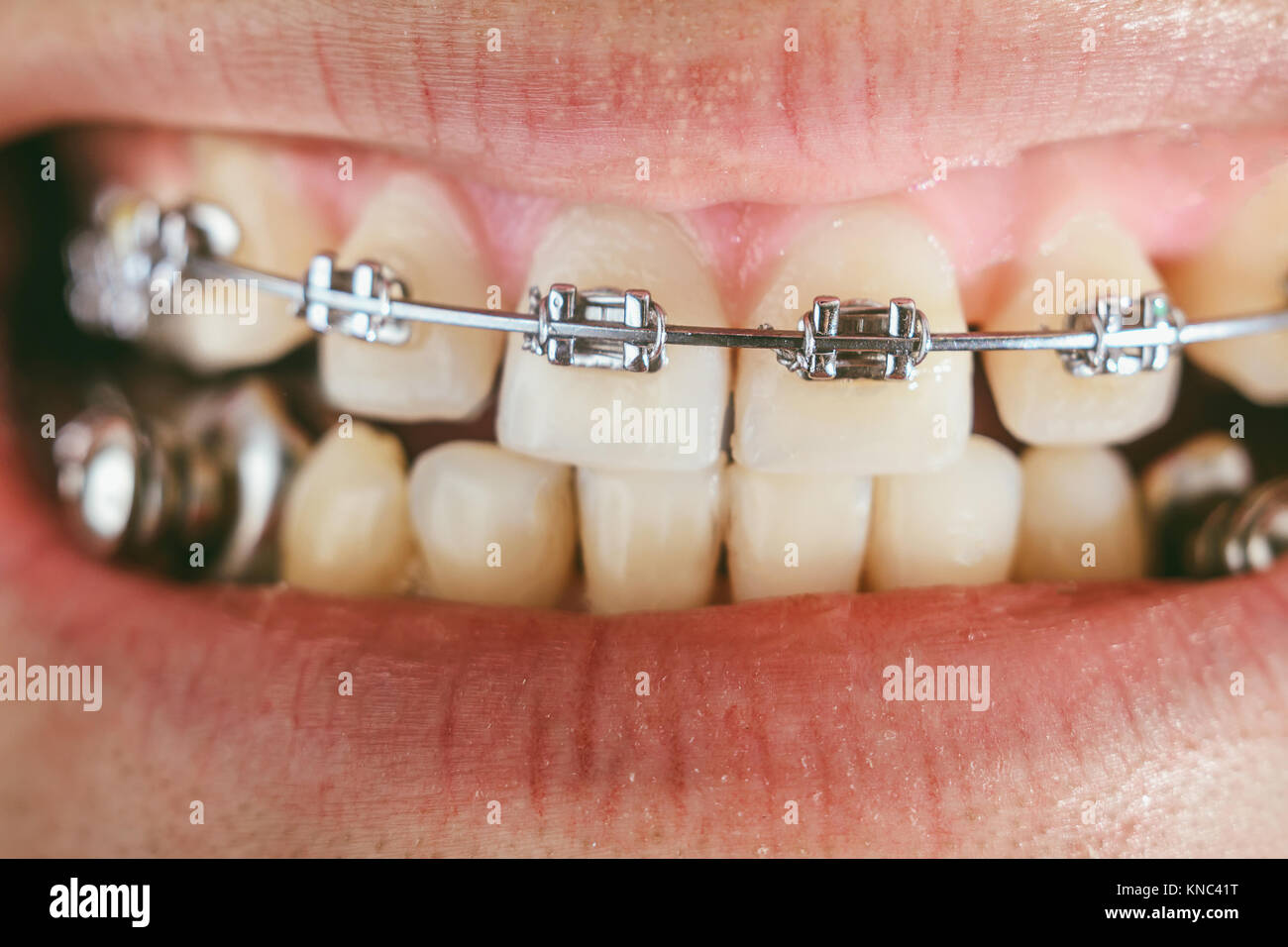 Metal braces teeth hires stock photography and images Alamy