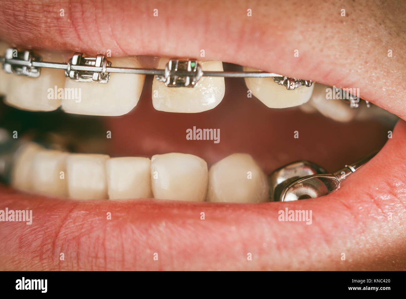 Dental appliance for deep bite Stock Photo Alamy