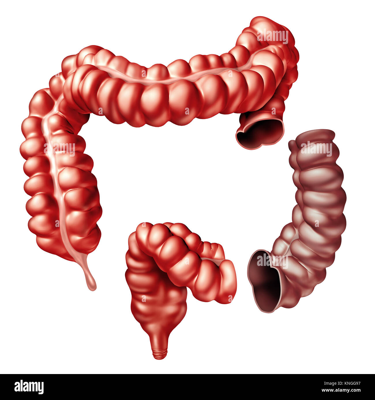 Colectomy colon surgery medical procedure removing a portion of the large intestine as a 3D intestine. Stock Photo