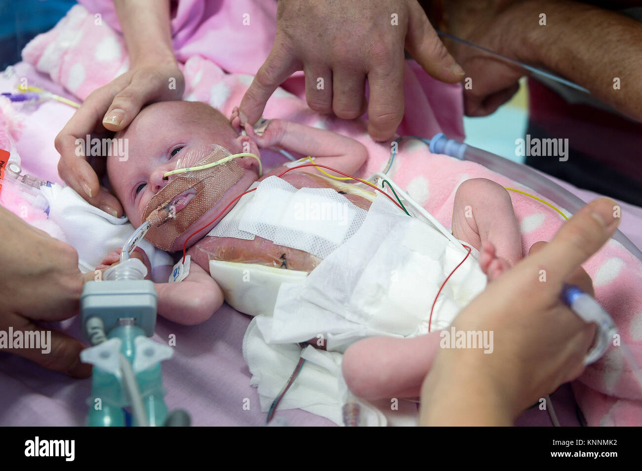 Three-week-old Vanellope Hope Wilkins, who was due to be delivered on Christmas Eve before an incredibly rare condition, in which the heart grows on the outside of the body, meant she had to be born prematurely by caesarean section on November 22, is caressed and touched by her parents Naomi Findlay and Dean Wilkins, at Glenfield Hospital in Leicester, after surviving, in what is believed to be a UK first. Stock Photo