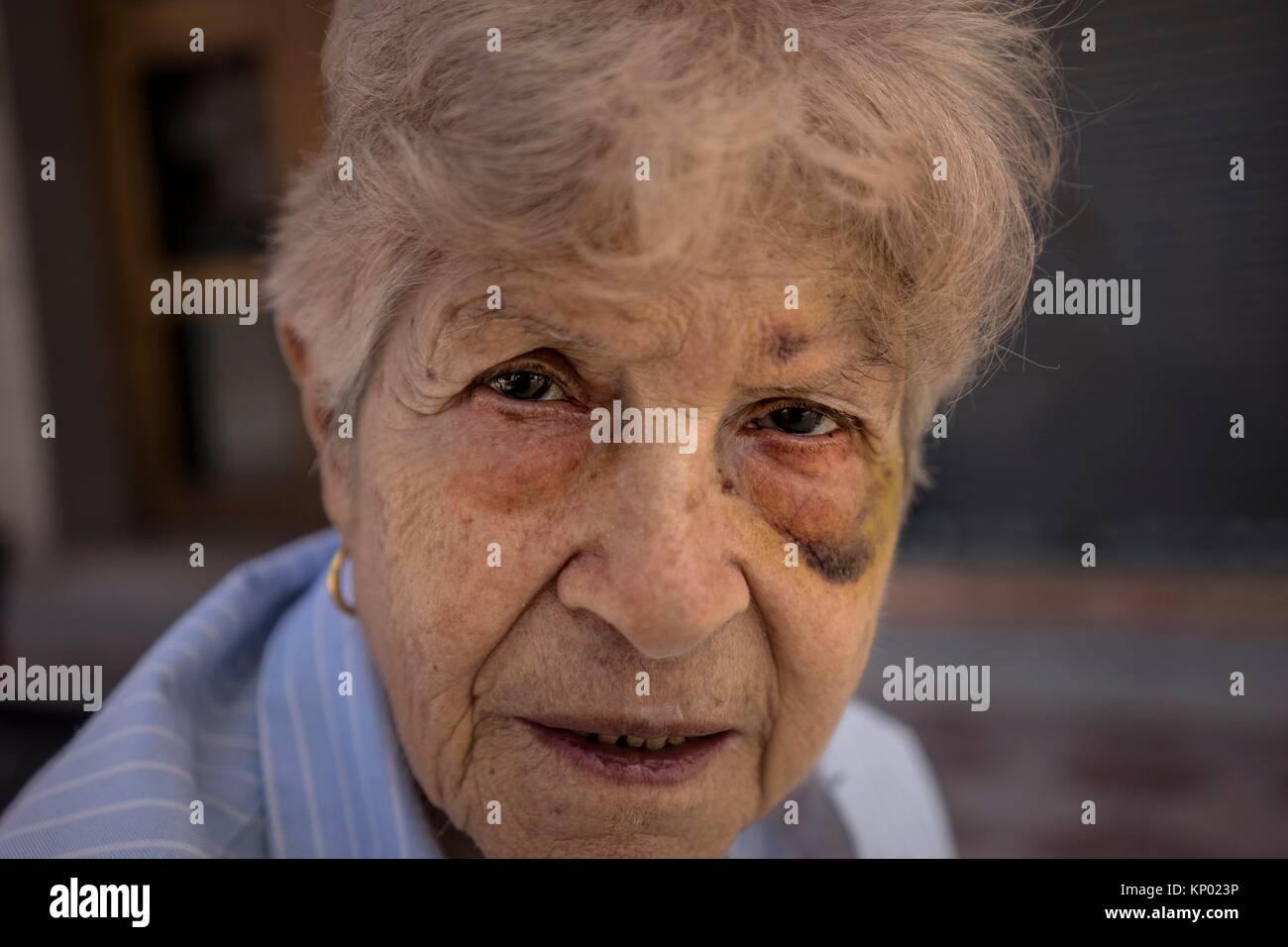 Battered woman battered woman black eye hires stock photography and