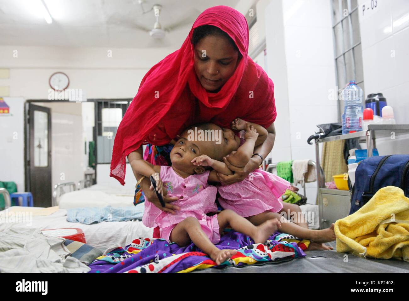 Bangladeshi conjoined baby girls twins Rabia and Rukia admitted in Hospital  at Dhaka on July 24, 2017. Delivered by caesarean at the PDC Clinic in  Stock Photo - Alamy