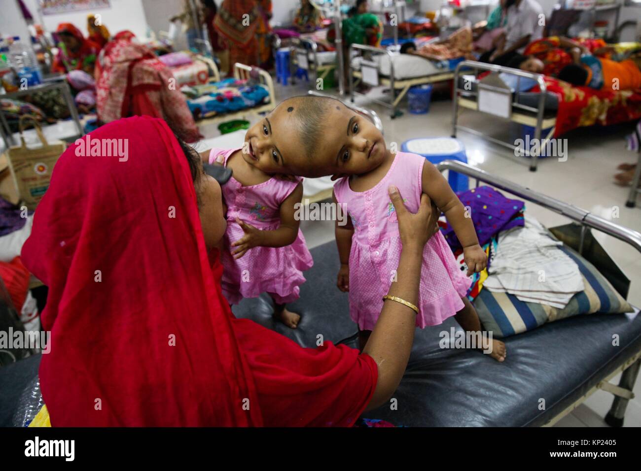 Bangladeshi conjoined baby girls twins Rabia and Rukia admitted in Hospital at Dhaka on July 24, 2017. Delivered by caesarean at the PDC Clinic in Stock Photo