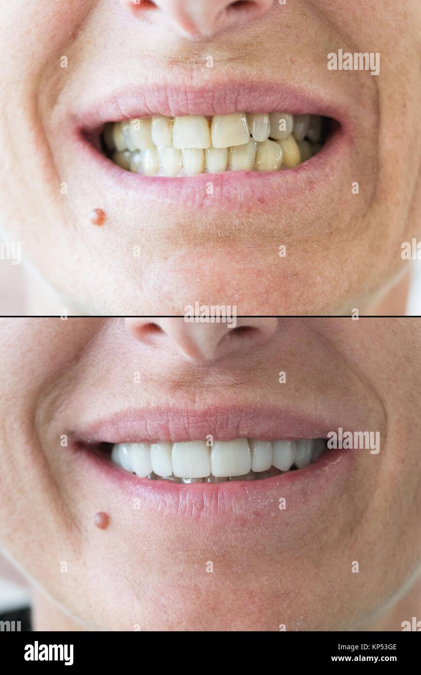 Dental facets placed by a dentist ( patient before and after surgery
