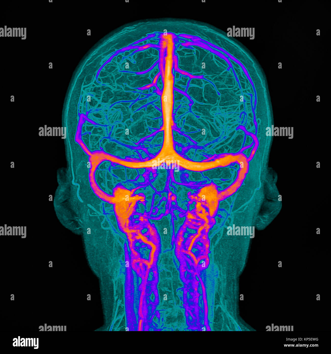 Intracranial blood vessels, Illustration based on a coloured magnetic resonance imaging (MRI) scan of a human brain and its intracranial blood vessels Stock Photo