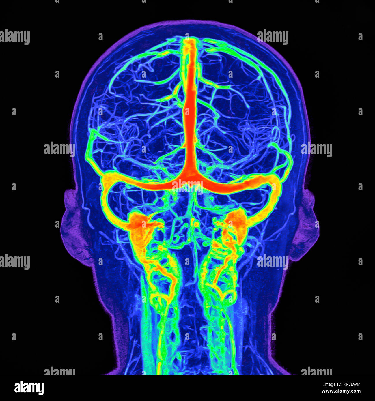 Intracranial blood vessels, Illustration based on a coloured magnetic resonance imaging (MRI) scan of a human brain and its intracranial blood vessels Stock Photo