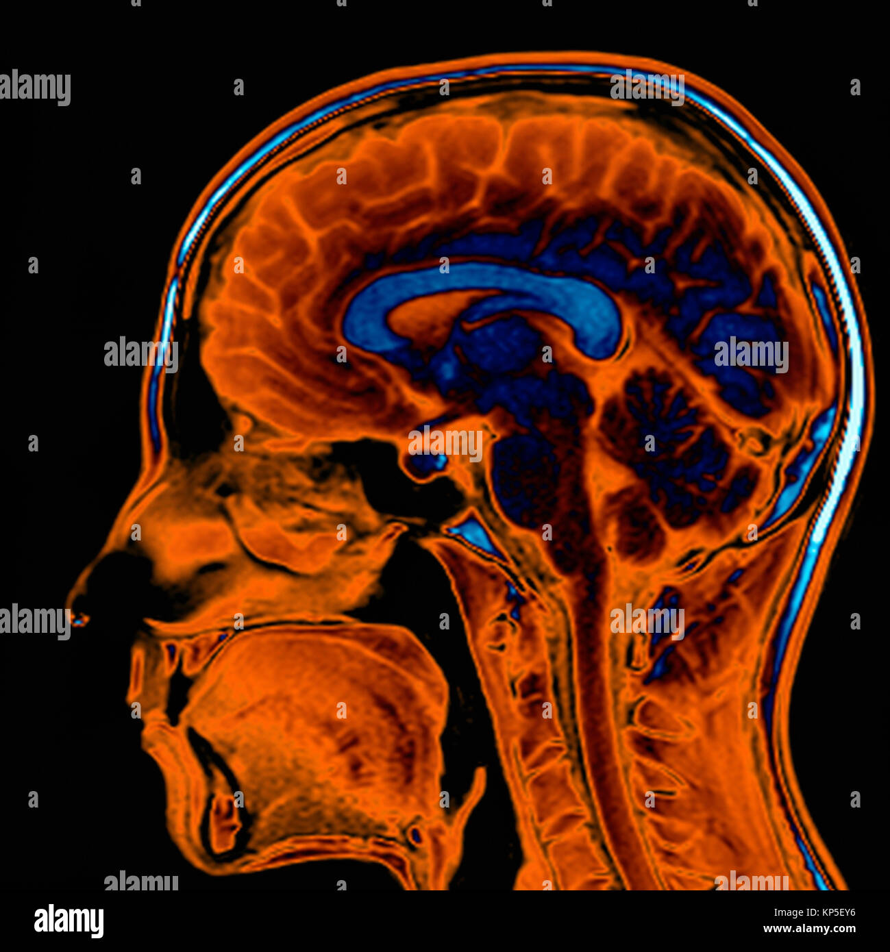 Coloured magnetic resonance imaging (MRI) scan of a sagittal section through a patient's head showing a healthy human brain. Stock Photo