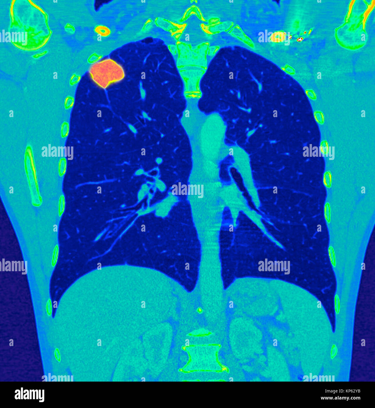 Coloured CTscan of the upper chest showing a tumor in the lung. Stock Photo