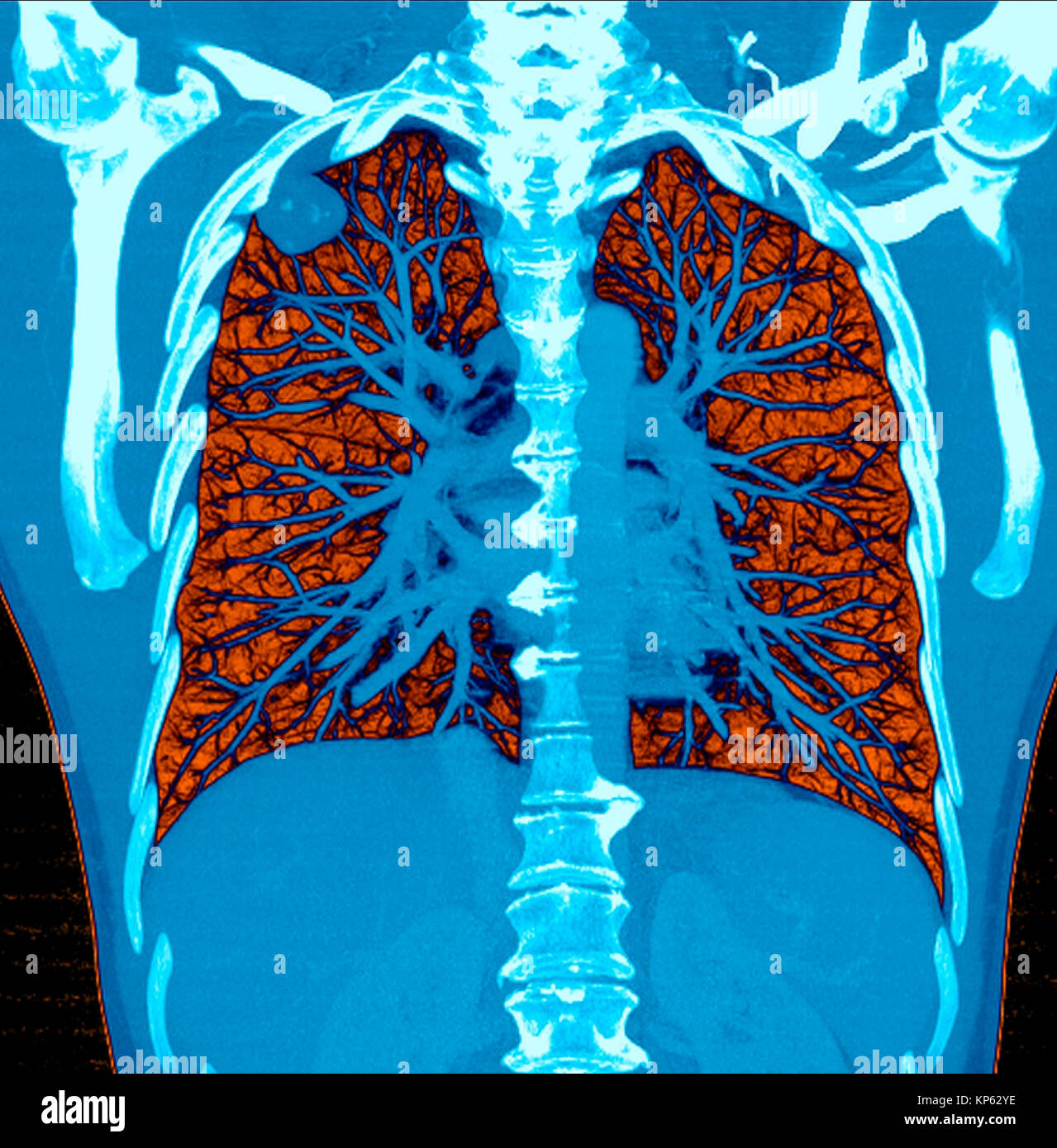 Coloured CTscan of the upper chest showing a tumor in the lung. Stock Photo