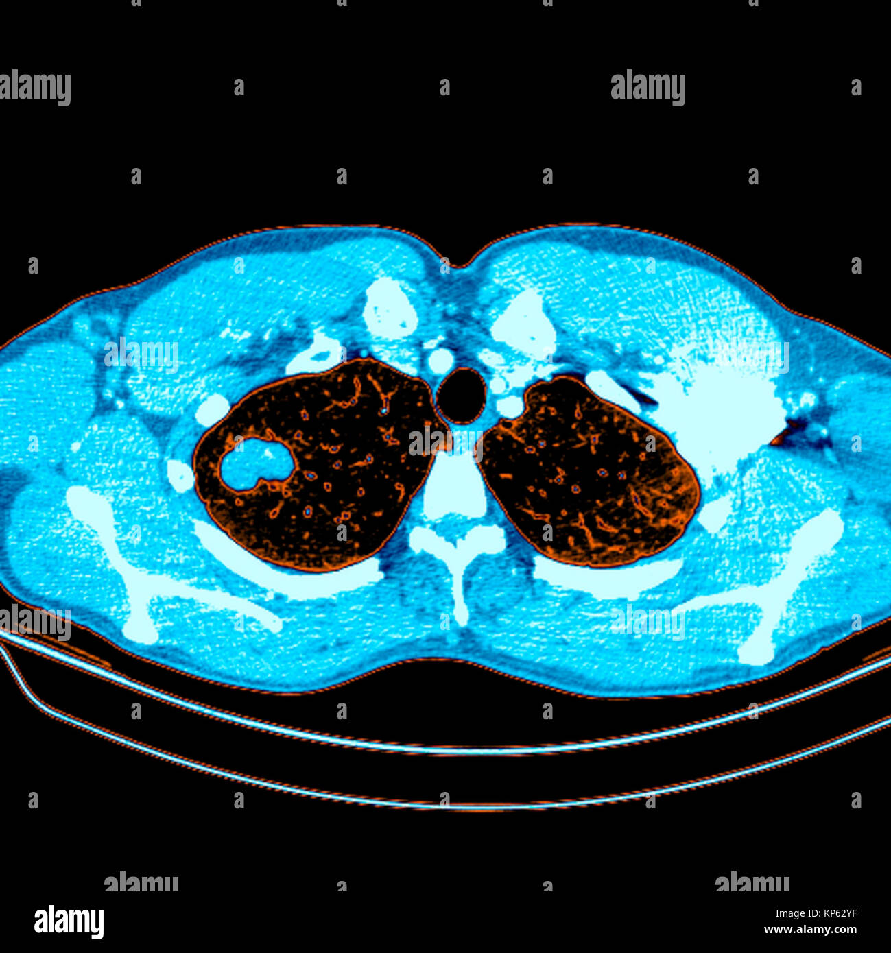 Coloured CTscan of the upper chest showing a tumor in the lung. Stock Photo