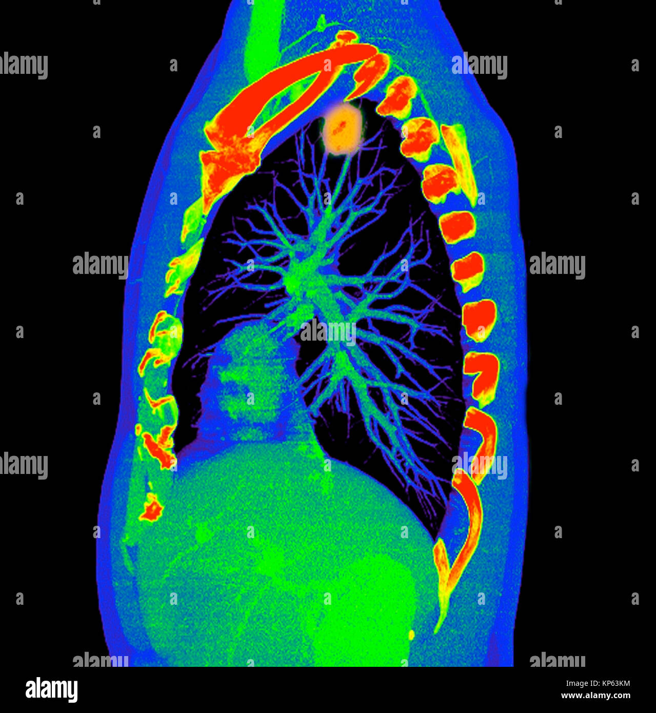 Coloured CTscan of the upper chest showing a tumor in the lung. Stock Photo