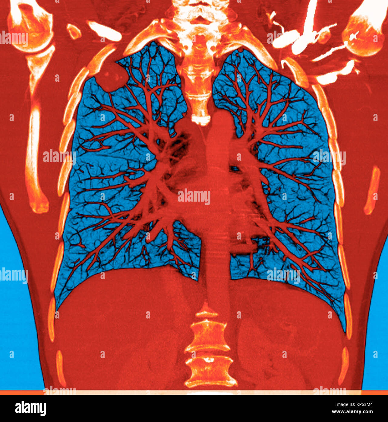 Coloured CTscan of the upper chest showing a tumor in the lung. Stock Photo