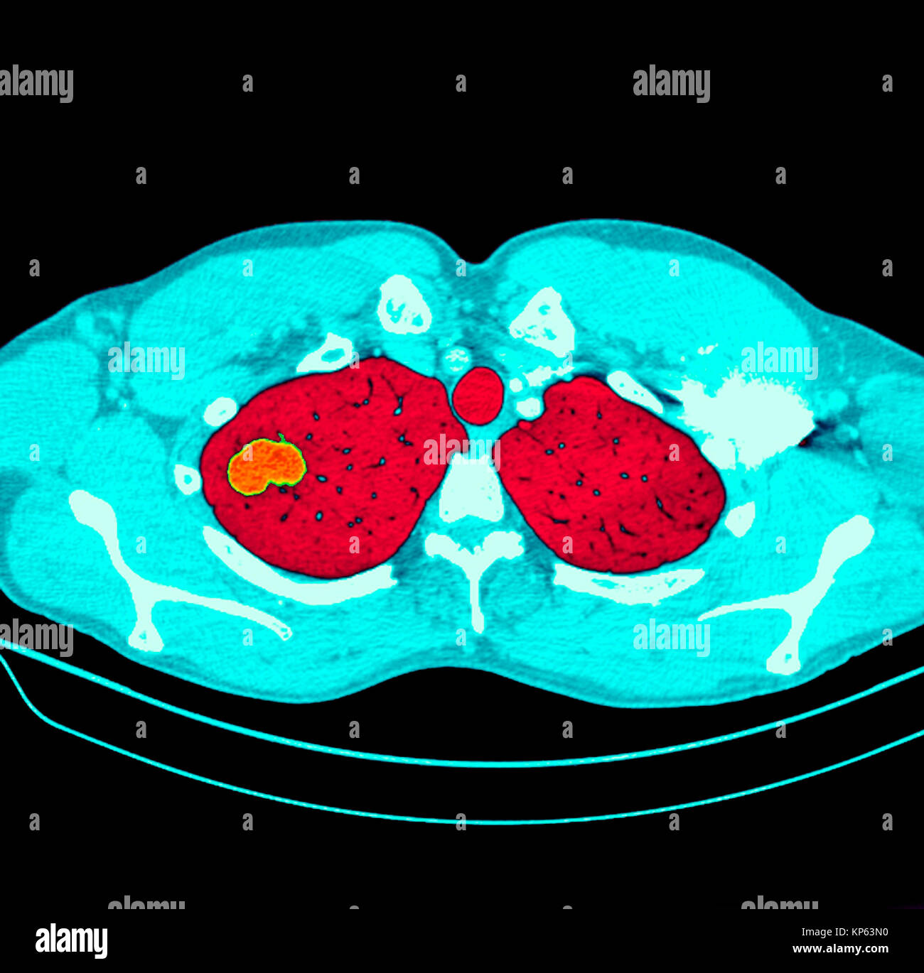 Coloured CTscan of the upper chest showing a tumor in the lung. Stock Photo