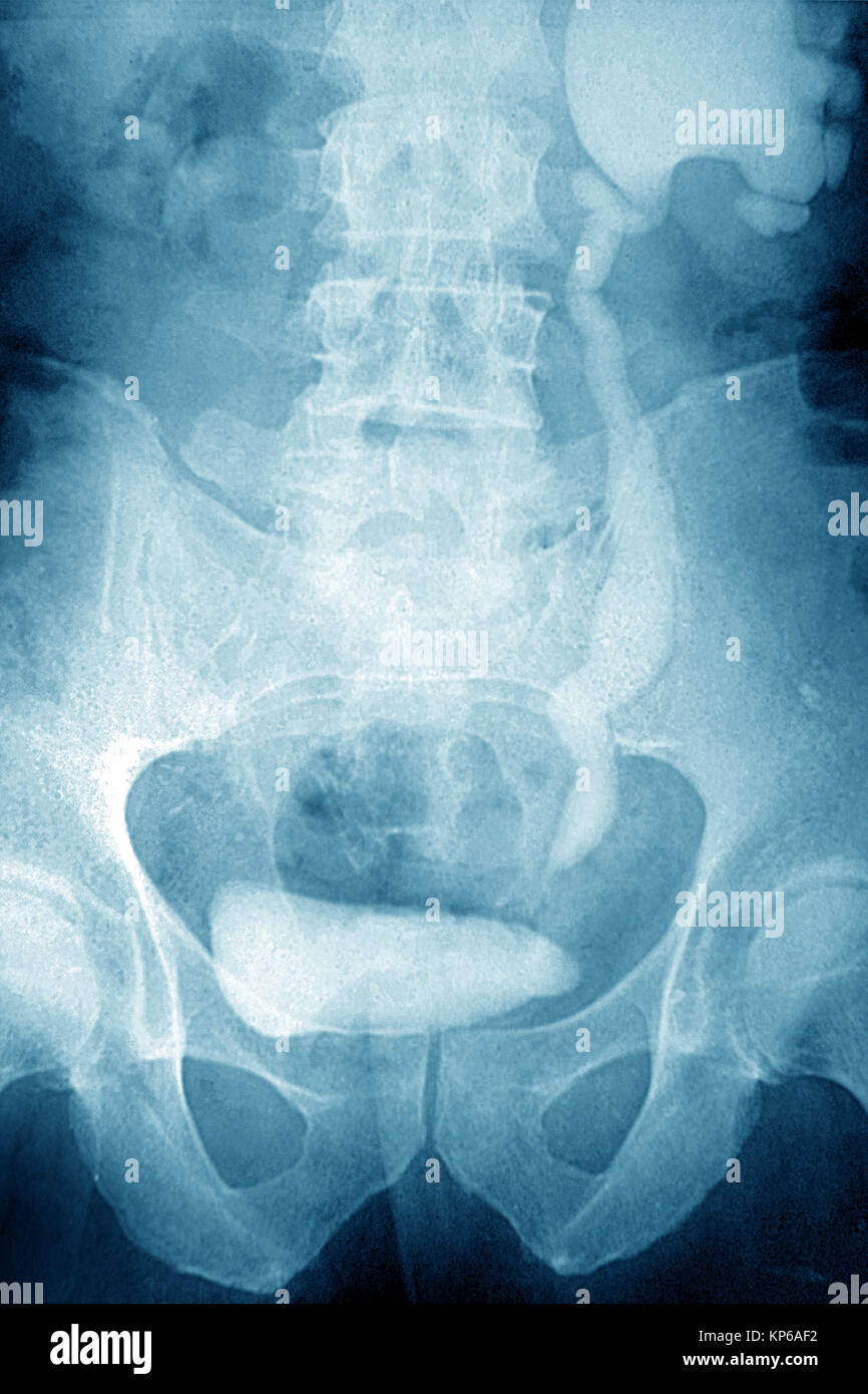 NEPHRITIC COLIC, XRAY Stock Photo Alamy