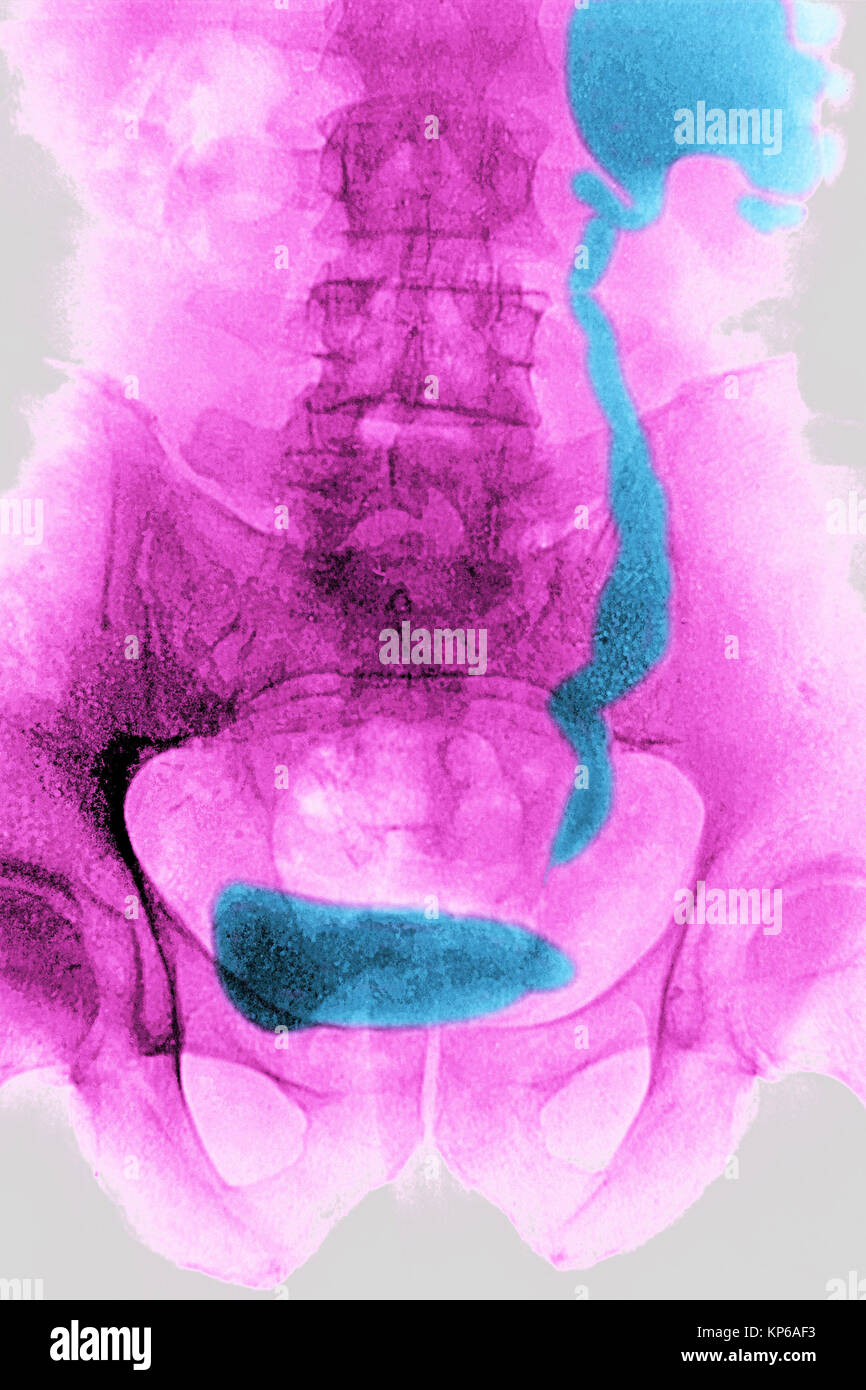 NEPHRITIC COLIC, XRAY Stock Photo Alamy