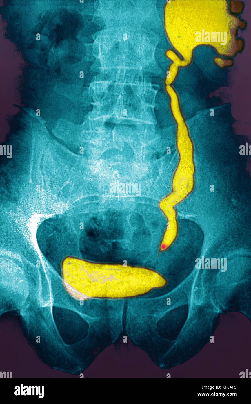 NEPHRITIC COLIC, XRAY Stock Photo Alamy