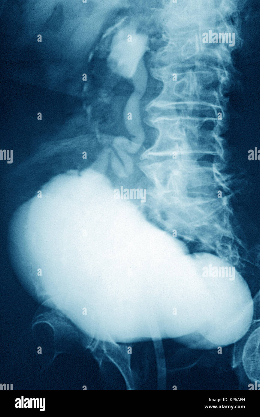 DIVERTICULUM IN BLADDER, XRAY Stock Photo Alamy