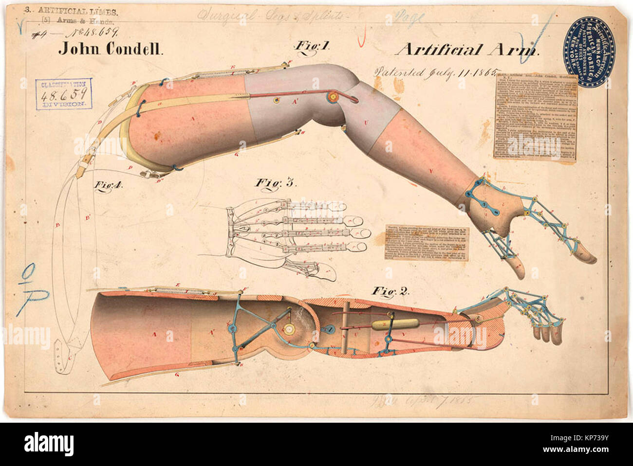 John Condell, Artificial Arm Patented July 11, 1865 Stock Photo