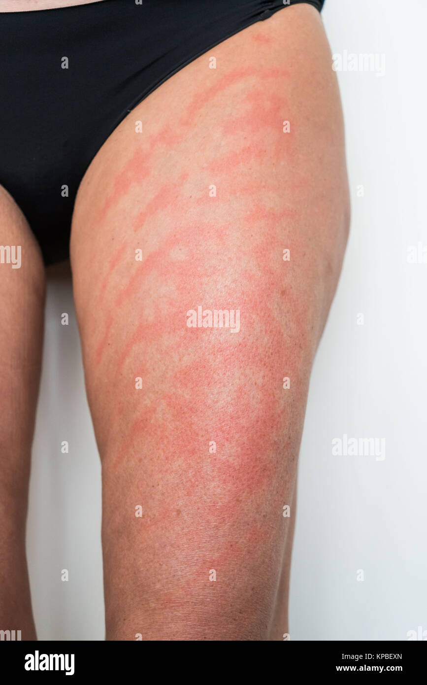 Allergic contact dermatitis to dyes contained in textiles Stock Photo