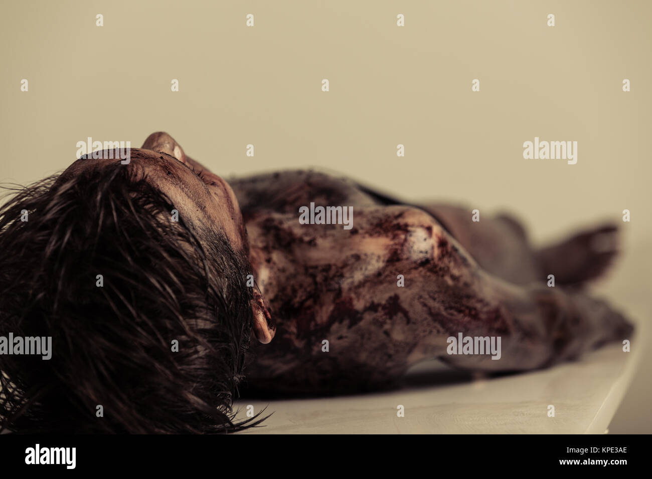 Burnt Body of a Dead Boy Lying on Table in Morgue Stock Photo