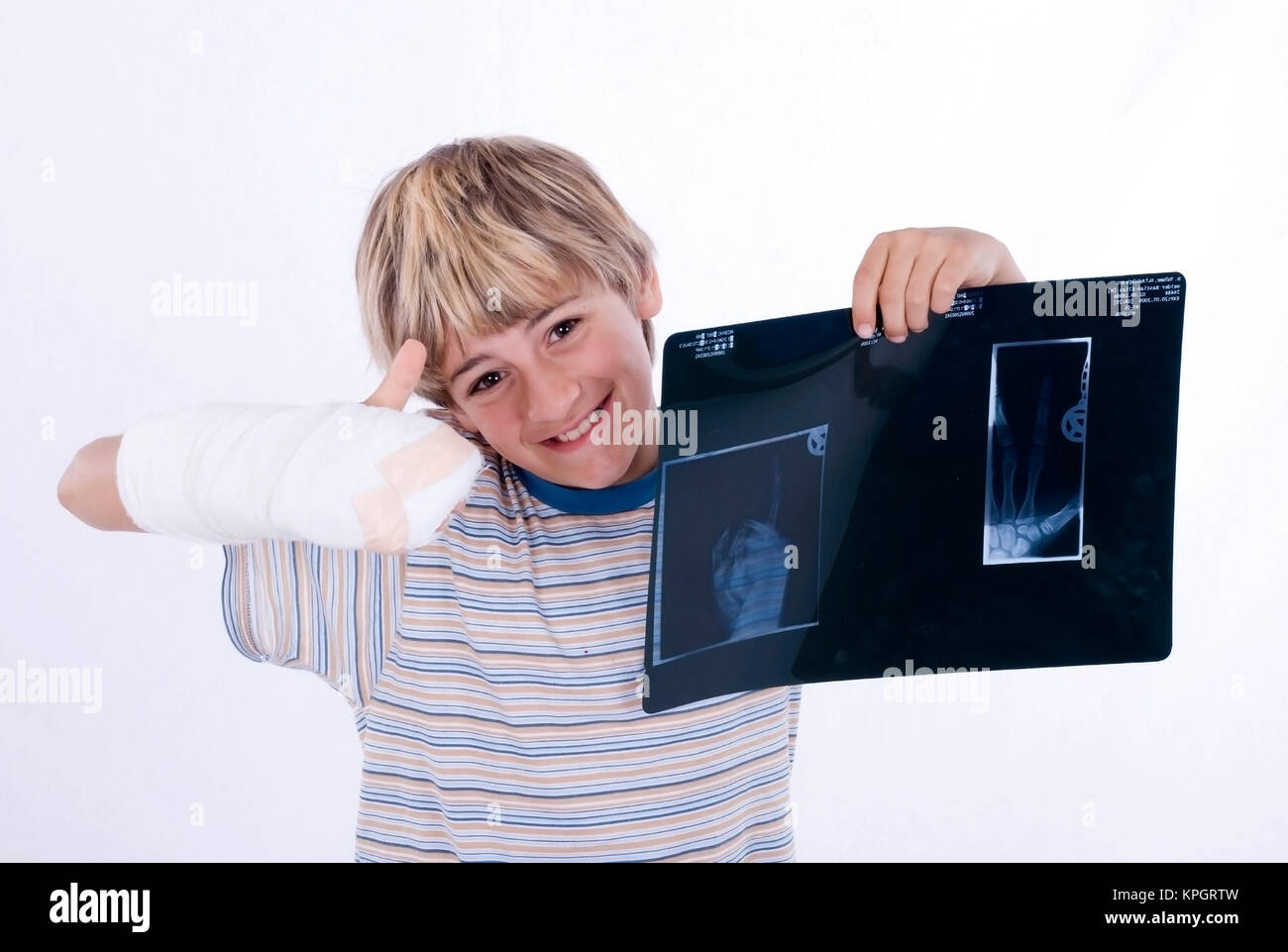 Junge, 11, mit Gipshand und Roentgenaufnahme - boy with arm in plaster and x-ray Stock Photo