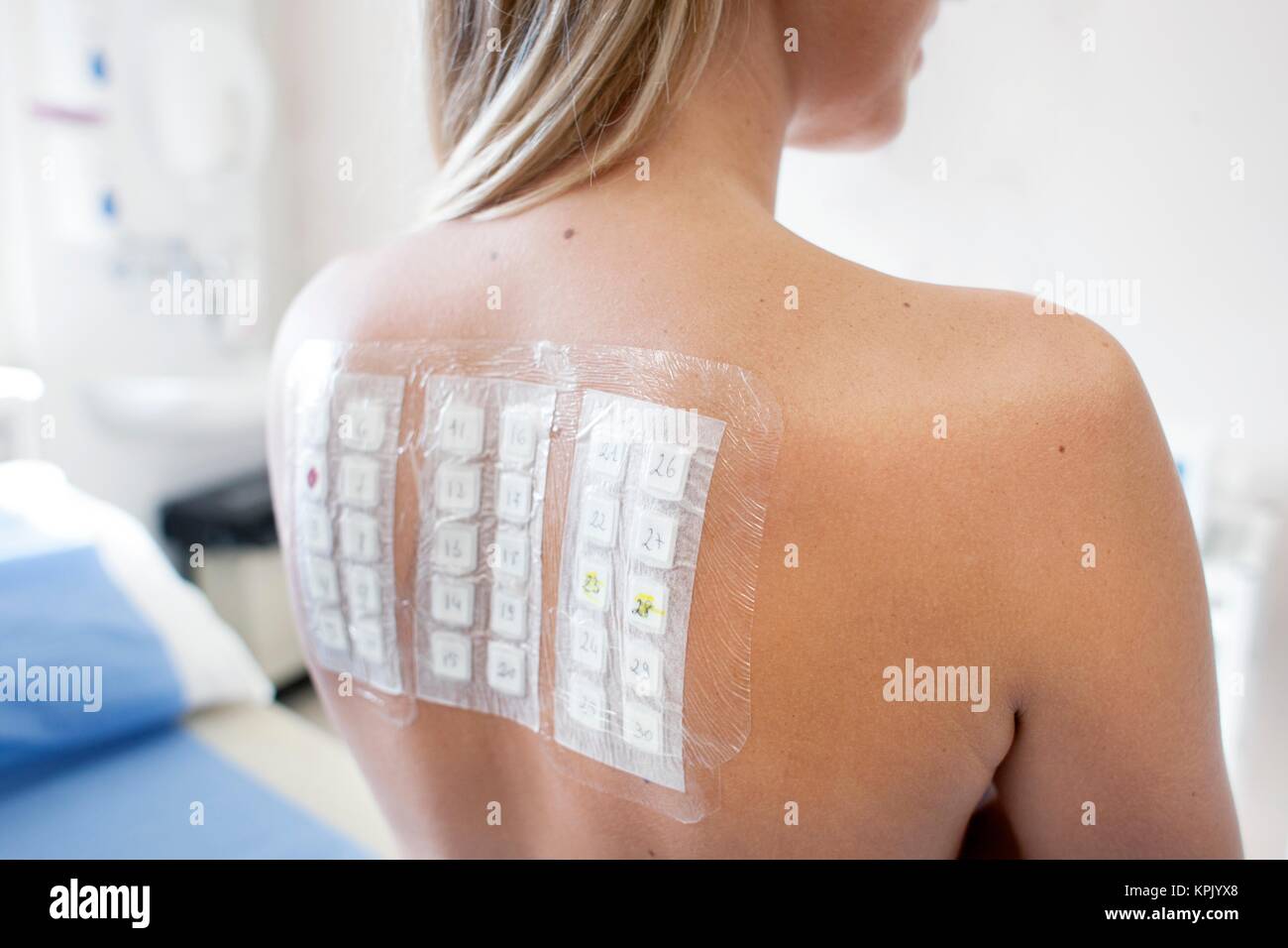 Patient undergoing a patch test in allergy clinic. Stock Photo
