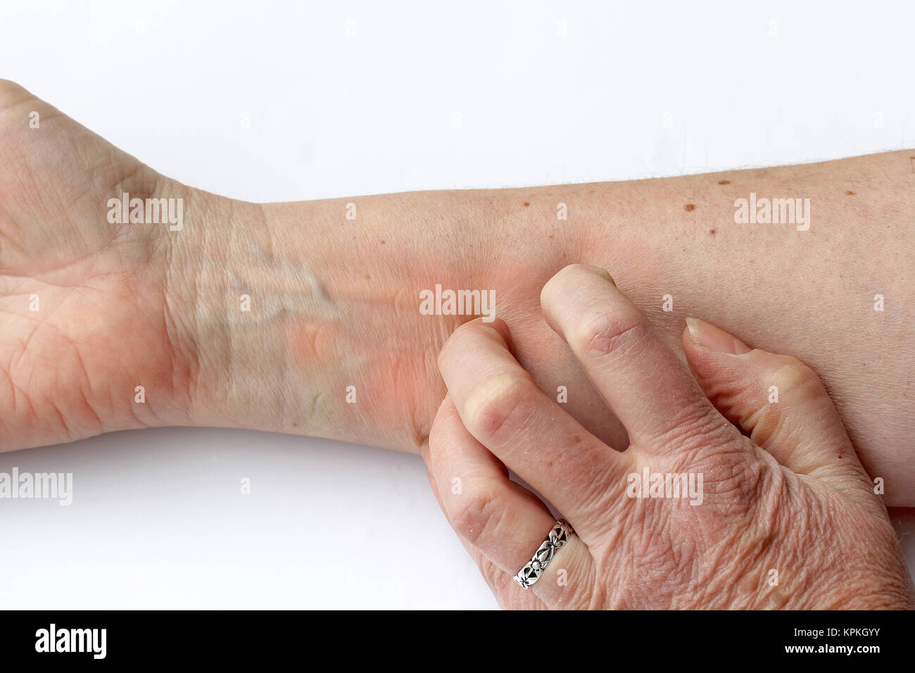 itchy red skin - a woman scratches her arm Stock Photo