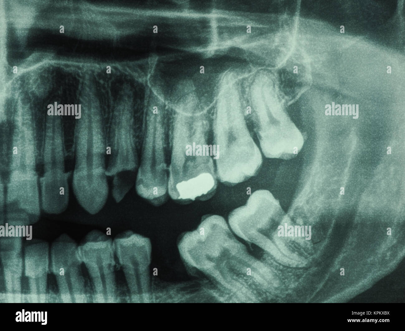 сменный прикус 8-10 лет оптг. резорбция корня молочного зуба. коренные зубы снимок. коренные зубы снимок. коренные зубы снимок.