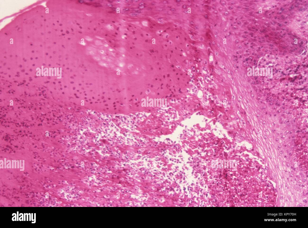 Micrograph demonstrating the histologic changes in human skin caused by smallpox, prepared with hematoxylin-eosin stain, 1975. Image courtesy CDC. Stock Photo