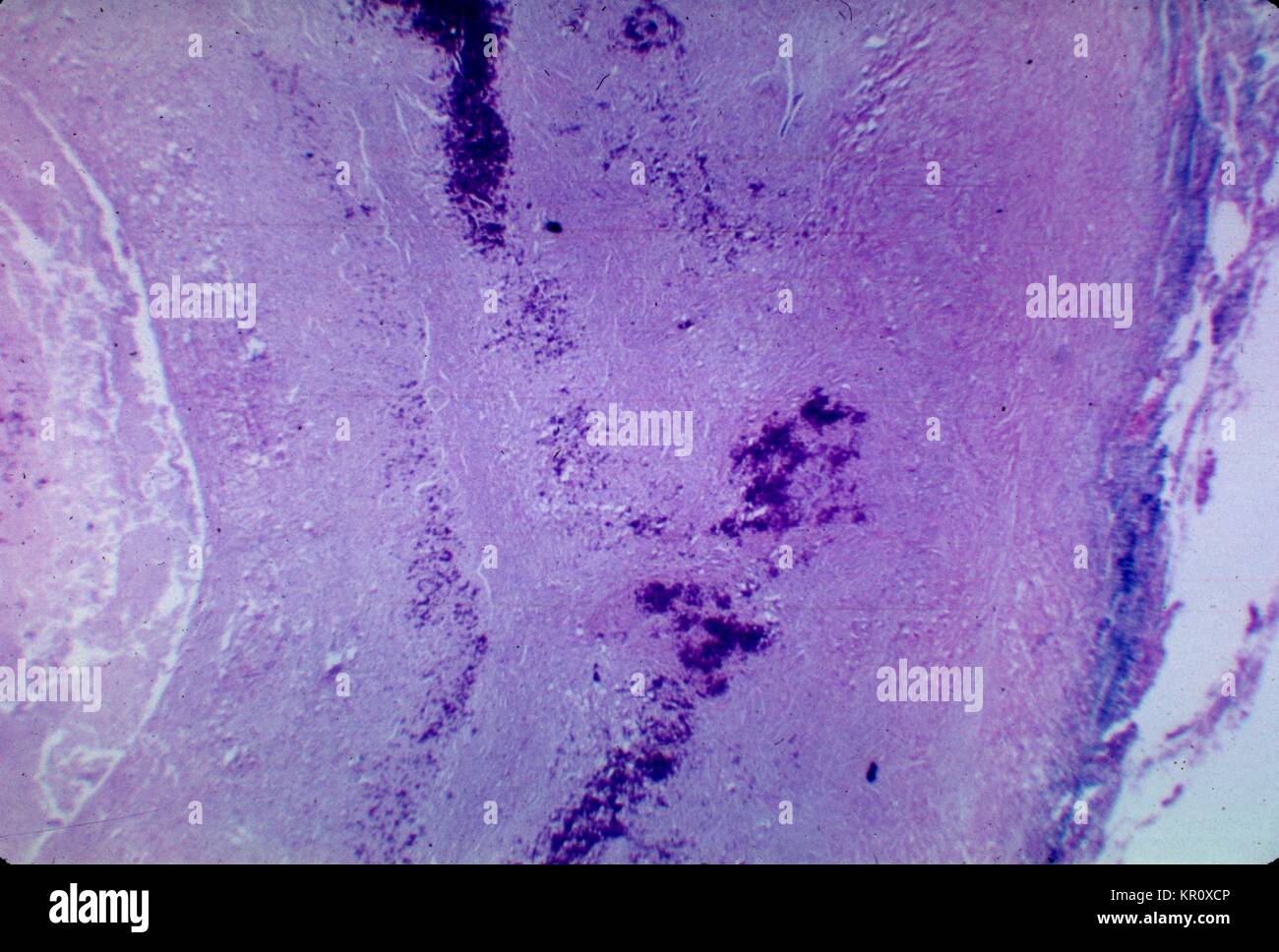 This partially calcified fibrocaseous nodule depicts the histopathologic changes associated with Histoplasmosis of the lung, 1973. Histoplasma capsulatum grows in soil, and material contaminated with bat or bird droppings. Spores become airborne when contaminated soil is disturbed, and breathing the spores causes infection. The disease is not transmitted from person to person. Image courtesy CDC. Stock Photo