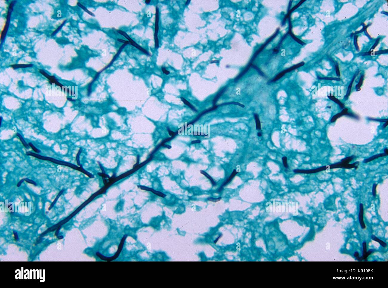 These encephalitic changes found in a 2 week old chicken brain were due to the fungal organism Ochroconis gallopavum, formerly Dactylaria gallopava, 1971. Ochroconis gallopavum, is found to affect wood workers who in the course of their work are exposed to airborne particulates containing this organism. Methenamine silver stain was used. Image courtesy CDC/Dr. Lucille Georg. Stock Photo