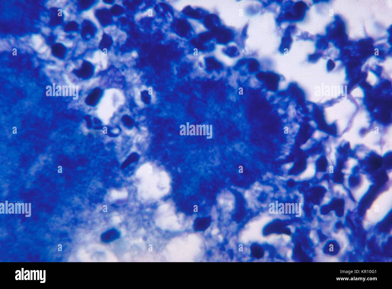 This micrograph depicts histopathologic changes due to the gram-positive organism, Actinomyces israelii, 1971. Using a modified Fite-Faraco stain, a ?. sulphur granule?. is shown in the middle of the image. These granules actually represent colonies of A. israelii, a gram-positive, anaerobic filamentous bacteria. Image courtesy CDC/Dr. Lucille Georg. Stock Photo