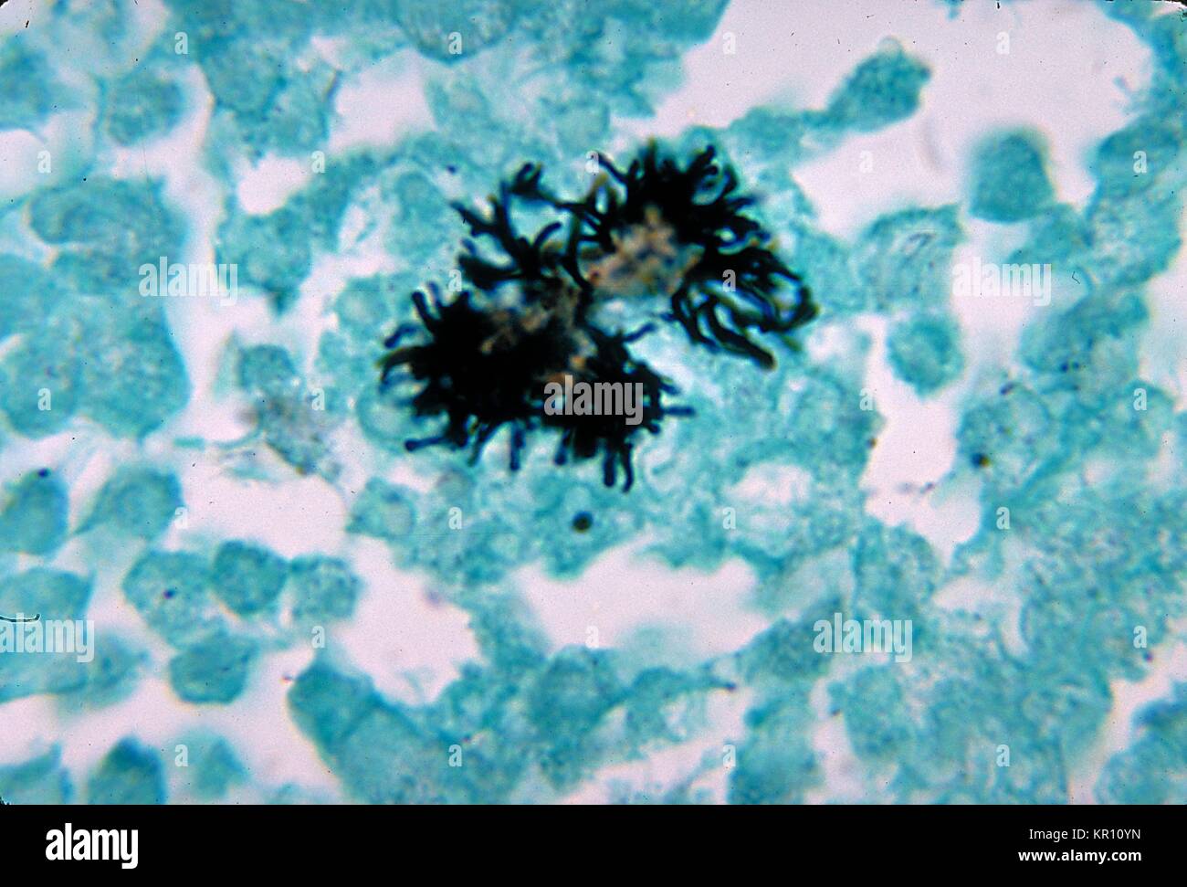 Formation of an abscess hires stock photography and images Alamy