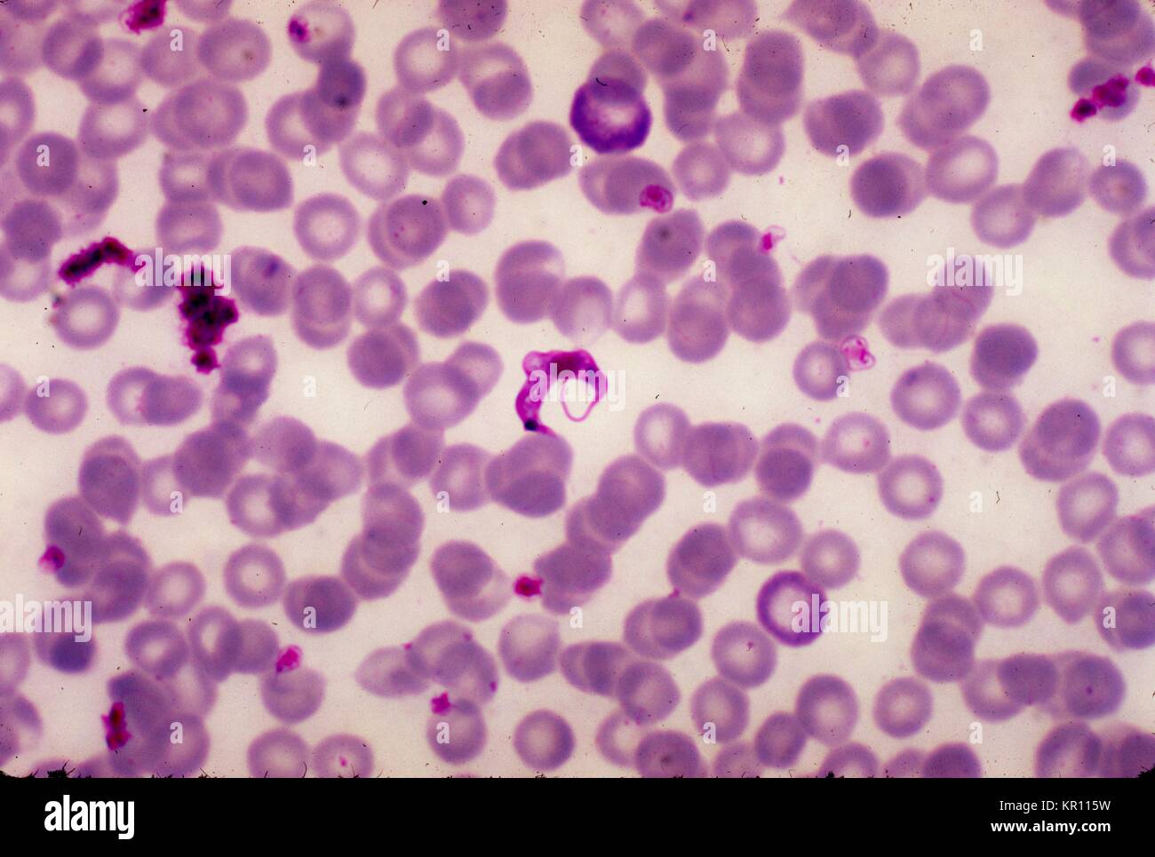 This is a micrograph of Trypanosoma cruzi in a blood smear using Giemsa staining technique, 1977. This protozoan parasite, T. cruzi, is the causative agent for Chagas disease, also known as ?. American trypanosomiasis?. It is estimated that 16 - 18 million people are infected with Chagas disease, and of those infected, 50, 000 will die each year. Image courtesy CDC/Dr. Mae Melvin. Stock Photo
