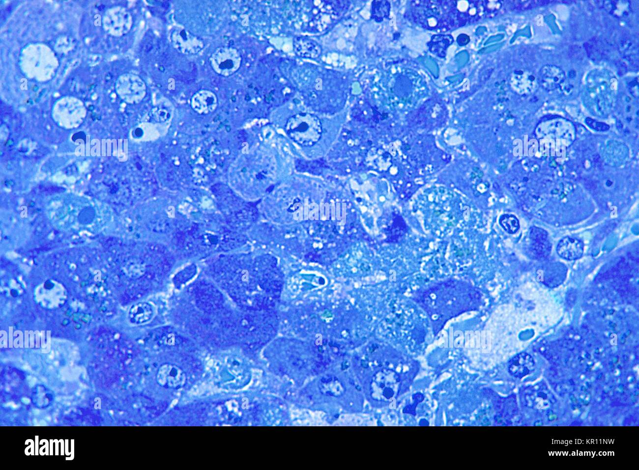 This photomicrograph shows hepatitis caused by the Lassa virus, using toluidine-blue azure II stain, 1972. The Lassa virus, which can cause altered liver morphology with hemorrhagic necrosis and inflammation, is a member of the family Arenaviridae, and is a single-stranded RNA, zoonotic, or animal-borne pathogen. Image courtesy CDC/Dr. W. Winn. Stock Photo