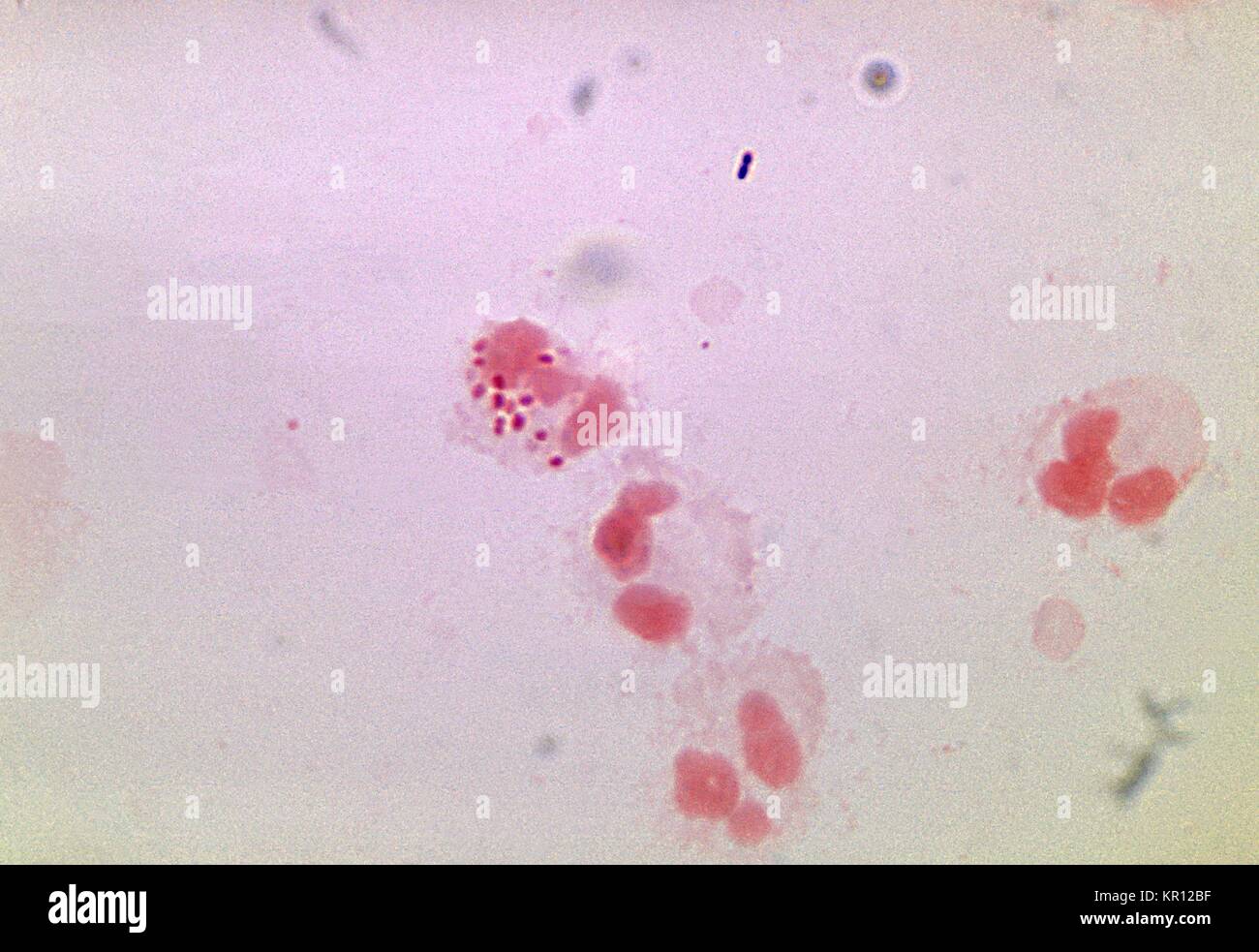 This photomicrograph depicts Neisseria gonorrhoeae bacteria within a neutrophil, 1972. N. gonorrhoeae, a gram-negative diplococcus, is the causative agent for Gonorrhea. Though these bacteria can infect the genital tract, mouth, and rectum they can become disseminated systemically throughout a person?s bloodstream. Image courtesy CDC/Dr. James Volk. Stock Photo