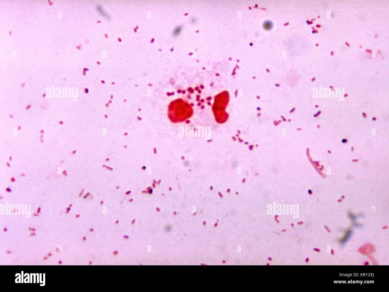 This is a photomicrograph of Neisseria gonorrhoeae the presence of mixed bacterial flora, 1972. Note the necrotic neutrophil. In 2000, 358, 995 cases of gonorrhea were reported to the CDC. In the United States, approximately 75 percent of all reported cases of gonorrhea are found in younger persons aged 15 to 29 years of age. Image courtesy CDC/Dr. James Volk. Stock Photo