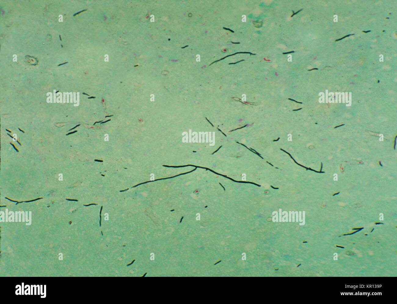 Note the histopathologic changes in this pigeon brain tissue using Methenamine silver stain due to Ochroconis gallopavum, formerly Dactylaria gallopava, 1976. Ochroconis gallopavum is a dematiaceous, or darkly appearing fungus, which causes cutaneous or subcutaneous infections, and is more likely to be associated with infections of the CNS that are usually limited to the brain. Image courtesy CDC/Dr. Libero Ajello. Stock Photo