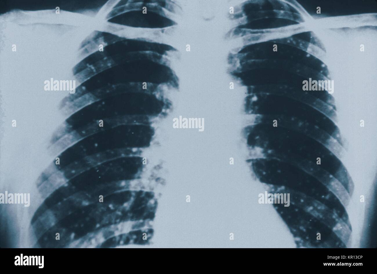 This anteroposterior (AP) chest xray revealed the presence of numerous