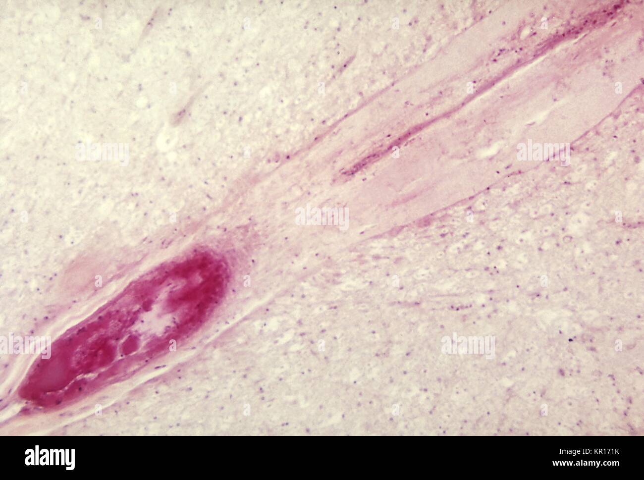 A photomicrograph of the lumbar spinal cord depicting an infarct due to Polio Type III surrounding the anterior spinal artery, 1964. When spinal neurons die, Wallerian degeneration takes place resulting in muscle weakness of those muscles once innervated by the now dead neurons (denervated). The degree of paralysis is directly correlated to the number of deceased neurons. Image courtesy CDC/Dr. Karp, Emory University. Stock Photo