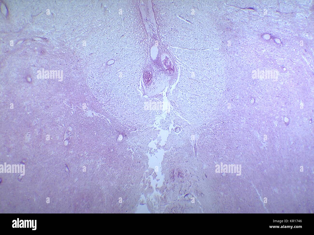 A photomicrograph of the lumbar spinal cord depicting degenerative changes due to an infarct caused by Polio Type III, 1964. When spinal neurons die, Wallerian degeneration takes place resulting in muscle weakness of those muscles once innervated by the now dead neurons (denervated). The degree of paralysis is directly correlated to the number of deceased neurons. Image courtesy CDC/Dr. Karp, Emory University. Stock Photo