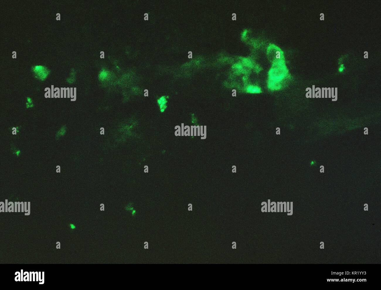 A photomicrograph of a chick chorioallantoic membrane, fluorescent antibody staining was done after smallpox virus inoculation, 1962. Chorioallantoic membrane infected with variola, stained with rabbit anti-vaccinia conjugate, then viewed using immunofluorescent microscopy technique. Image courtesy CDC/Dr. David Kirsh. Stock Photo