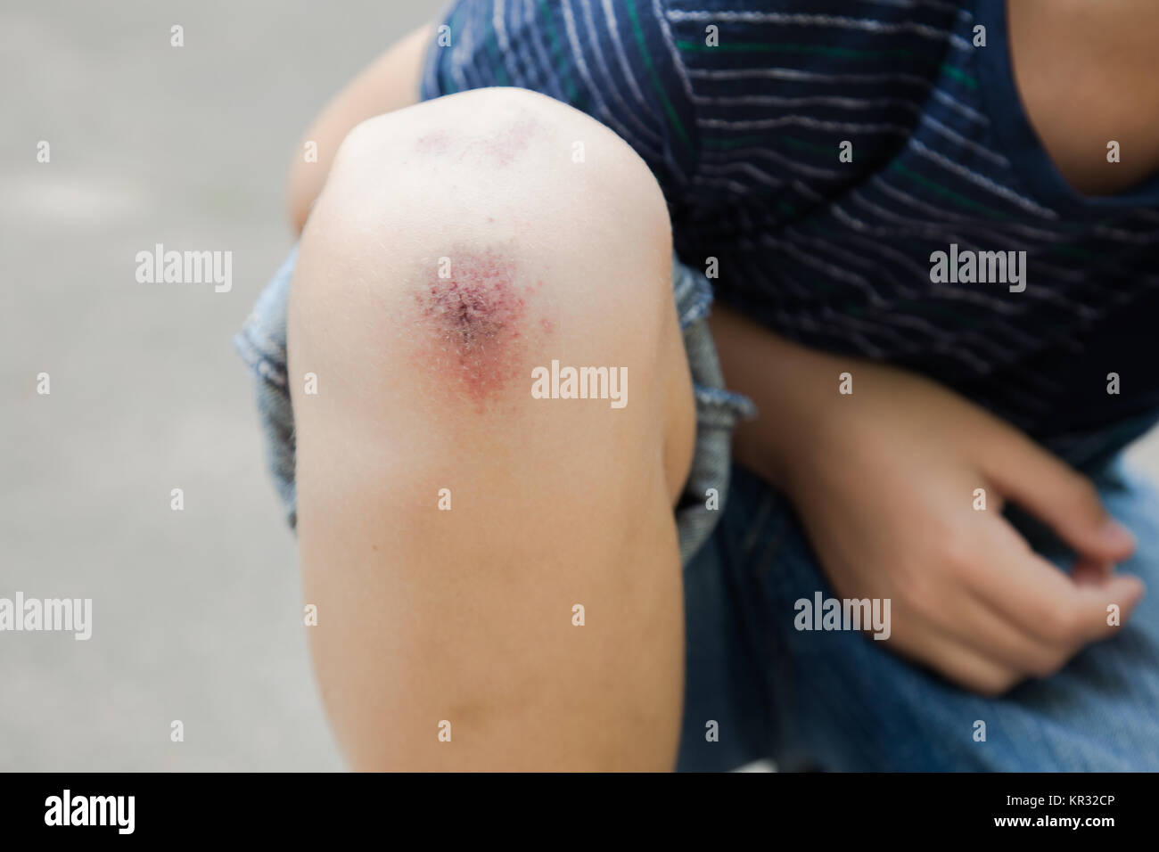 Closeup of injured young kid's knee after he fell down on pavement.  Horizontal color image. Stock Photo